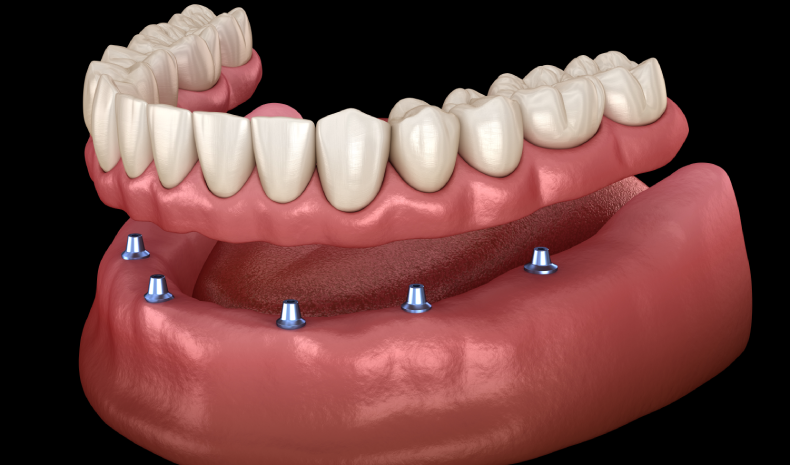 denture stabilization at Citrus Smiles Dental Studio