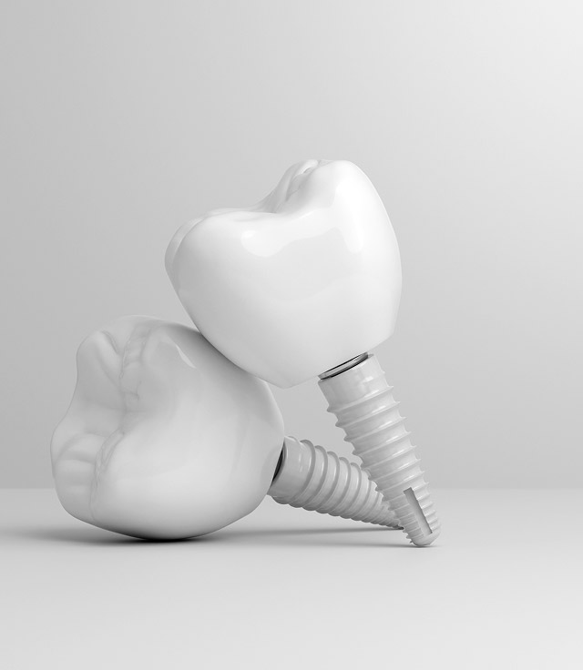 dental implants