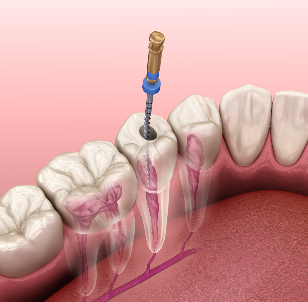 Illustration of root canal therapy procedure showing dental drill in tooth, highlighting tooth anatomy and treatment process, relevant to restorative dental care information.
