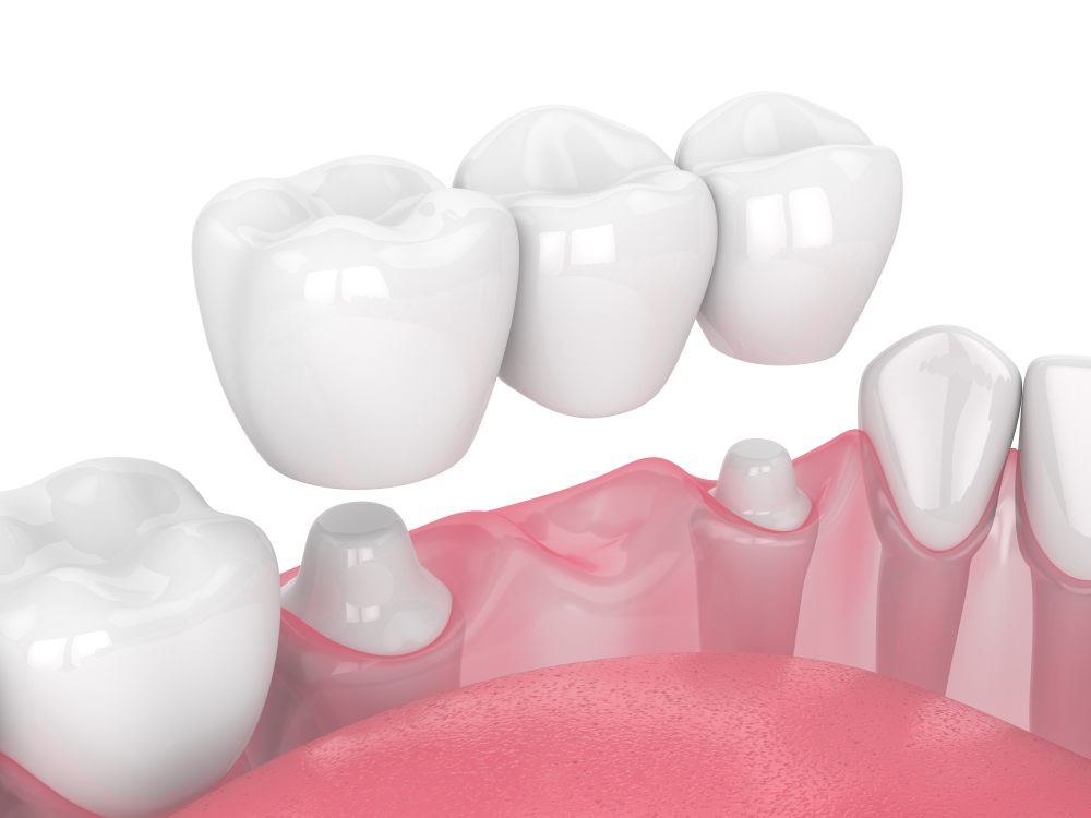 Dental bridge components, including crowns and pontics, illustrating restorative dentistry for replacing missing teeth, relevant to Citrus Smiles Dental Studio's services.