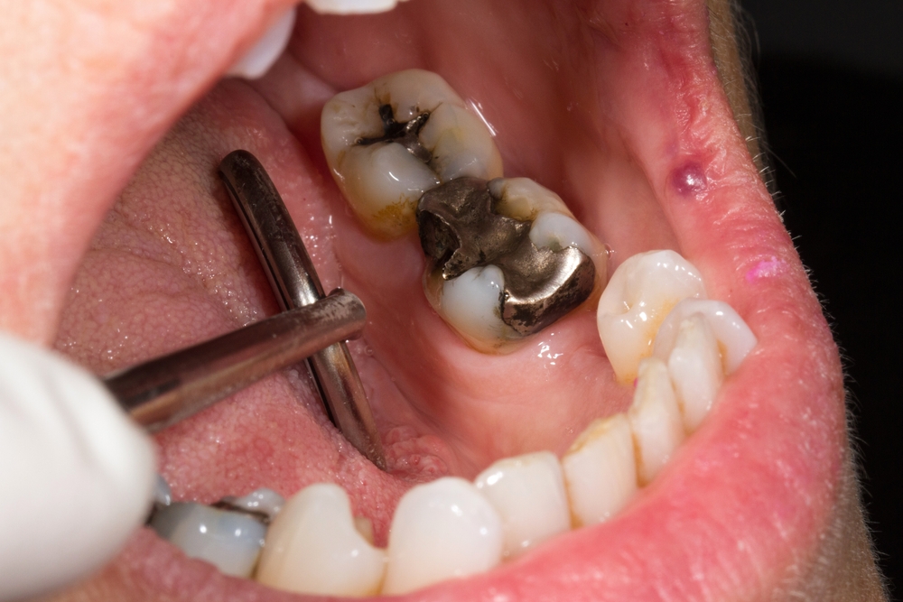 Image of a dental examination showing a tooth with a silver amalgam filling and surrounding healthy teeth, illustrating dental restoration techniques relevant to composite fillings.