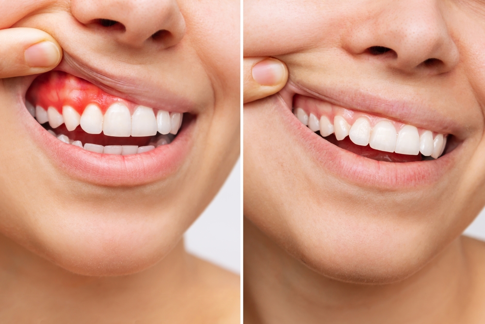 Before and after images of a person showing gum health improvement, highlighting swollen, bleeding gums on the left and healthy gums on the right, illustrating the benefits of scaling and root planing treatment for oral health.