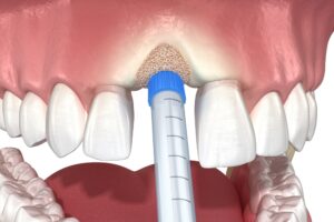 bone grafting