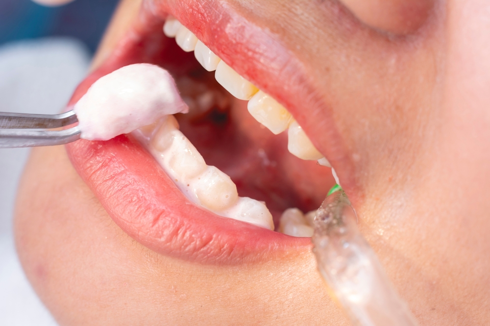 A,Dental,Professional,Using,Tweezers,To,Apply,A,Medicated,Paste Close-up of a patient's mouth during a teeth whitening procedure, featuring dental tools applying whitening gel to the teeth, highlighting the process of achieving a brighter smile at Citrus Smiles Dental Studio.