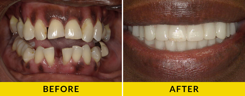 before and after treatment at Citrus Smiles Dental Studio