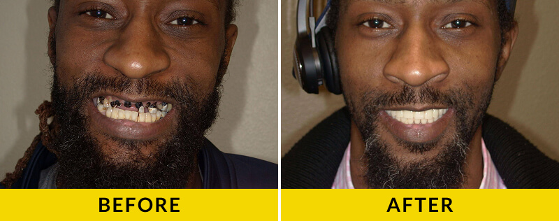 before and after treatment at Citrus Smiles Dental Studio