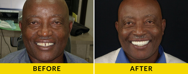 before and after treatment at Citrus Smiles Dental Studio