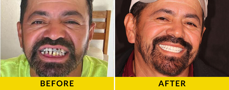 before and after treatment at Citrus Smiles Dental Studio