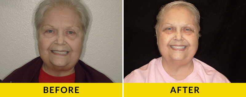 before and after treatment at Citrus Smiles Dental Studio