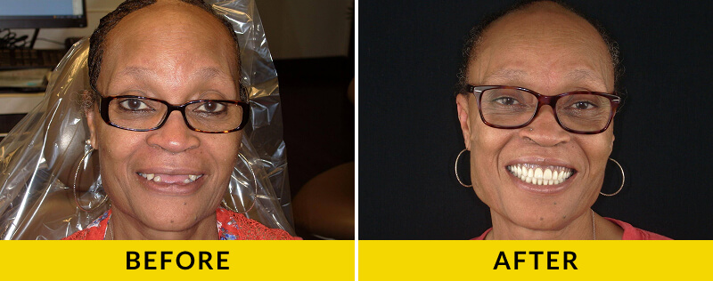 before and after treatment at Citrus Smiles Dental Studio
