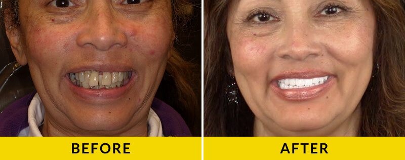 before and after treatment at Citrus Smiles Dental Studio