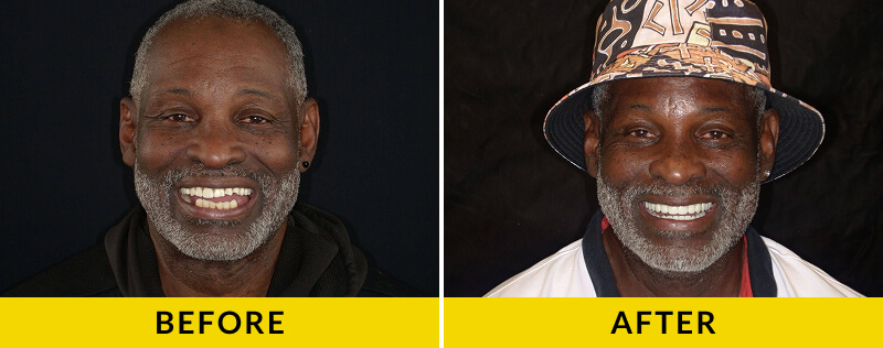 before and after treatment at Citrus Smiles Dental Studio