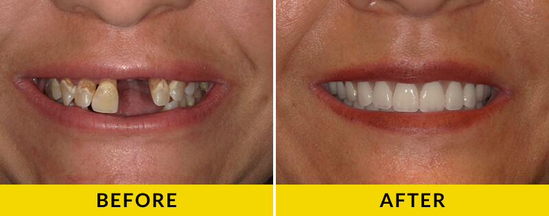 before and after treatment at Citrus Smiles Dental Studio