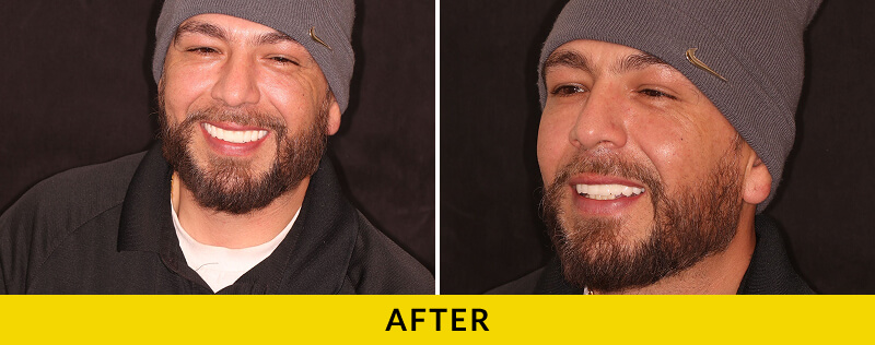 before and after treatment at Citrus Smiles Dental Studio