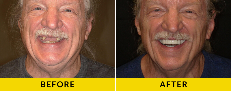 before and after treatment at Citrus Smiles Dental Studio