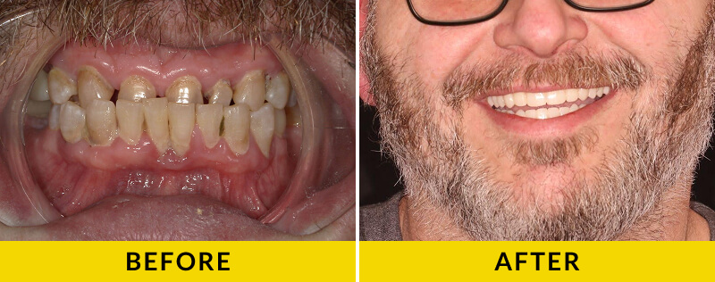 before and after treatment at Citrus Smiles Dental Studio