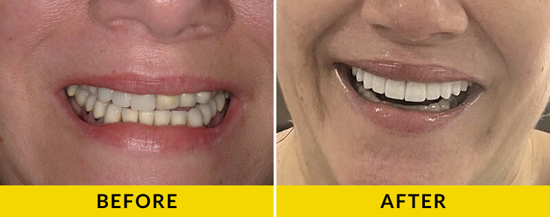 before and after treatment at Citrus Smiles Dental Studio