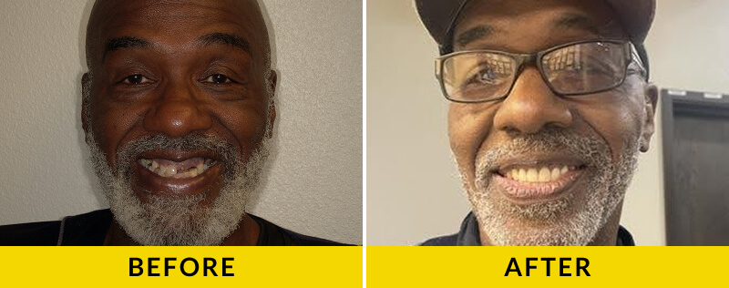 before and after treatment at Citrus Smiles Dental Studio