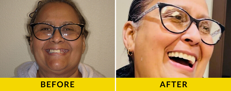 before and after treatment at Citrus Smiles Dental Studio