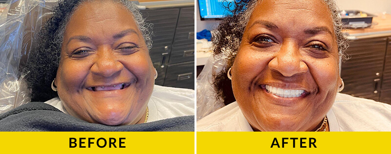 before and after treatment at Citrus Smiles Dental Studio