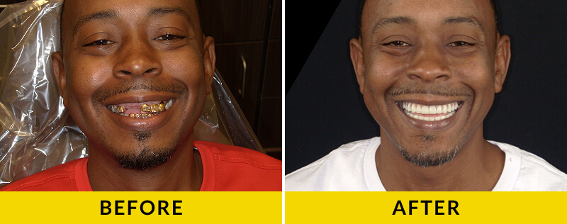 before and after treatment at Citrus Smiles Dental Studio