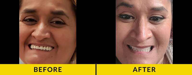 before and after treatment at Citrus Smiles Dental Studio