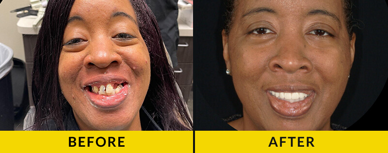 before and after treatment at Citrus Smiles Dental Studio
