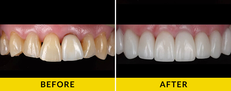 before and after treatment at Citrus Smiles Dental Studio
