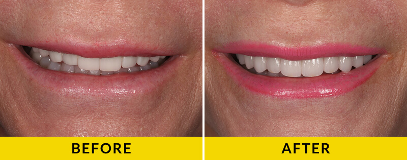 before and after treatment at Citrus Smiles Dental Studio