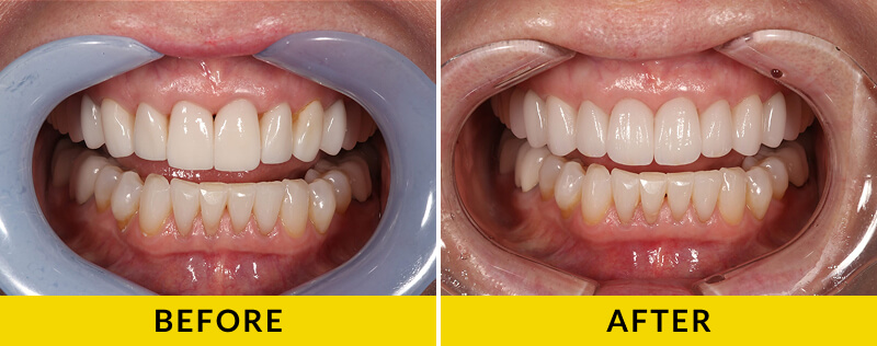 before and after treatment at Citrus Smiles Dental Studio