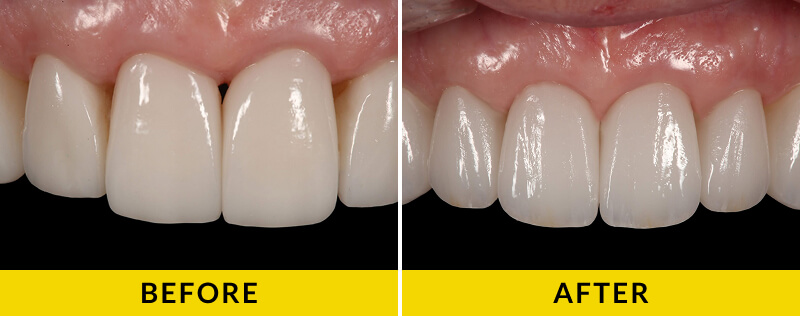 before and after treatment at Citrus Smiles Dental Studio