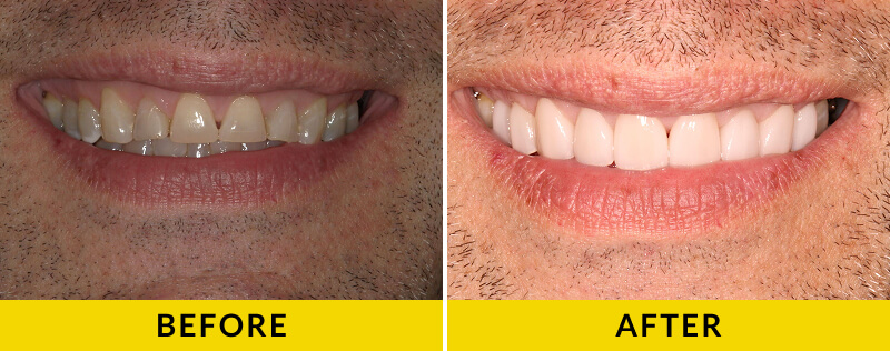 before and after treatment at Citrus Smiles Dental Studio