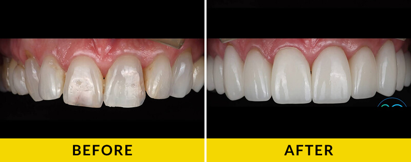 before and after treatment at Citrus Smiles Dental Studio