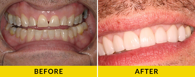 before and after treatment at Citrus Smiles Dental Studio