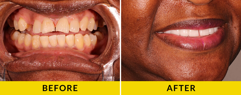 before and after treatment at Citrus Smiles Dental Studio