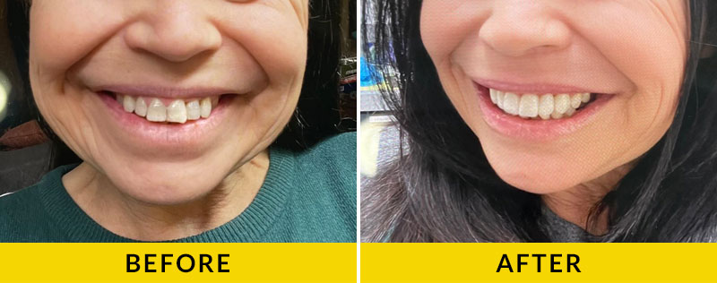 before and after treatment at Citrus Smiles Dental Studio