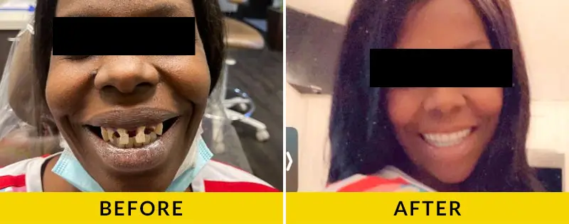 before and after treatment at Citrus Smiles Dental Studio