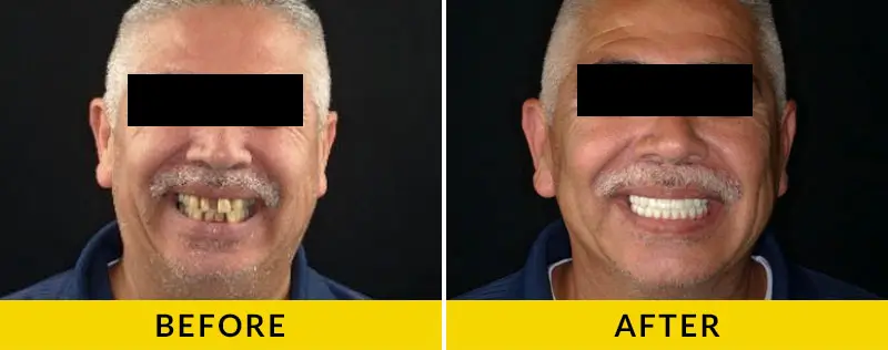 before and after treatment at Citrus Smiles Dental Studio