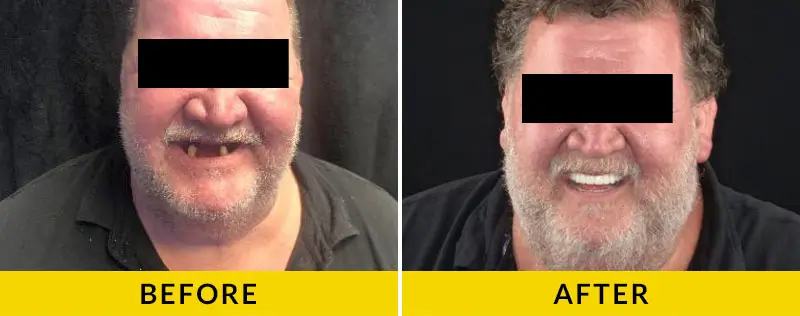 before and after treatment at Citrus Smiles Dental Studio