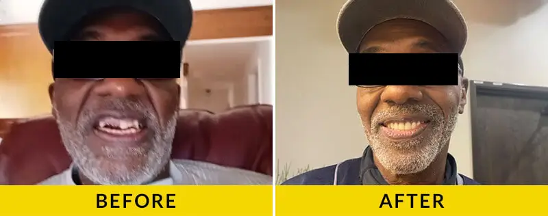 before and after treatment at Citrus Smiles Dental Studio