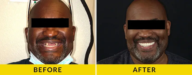 before and after treatment at Citrus Smiles Dental Studio