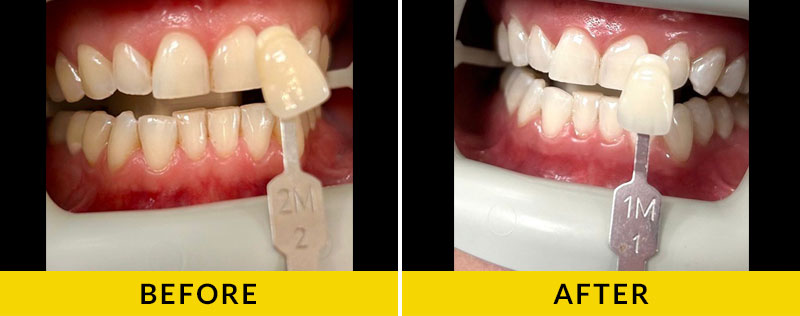 before and after treatment at Citrus Smiles Dental Studio