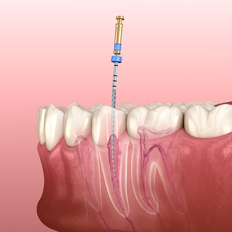 restorative dentistry at Citrus Smiles Dental Studio