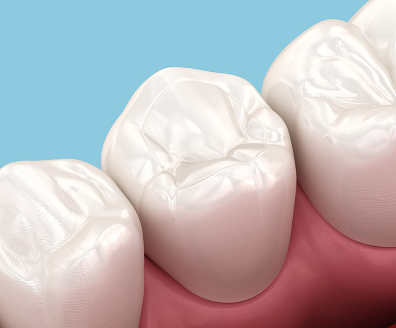 tooth-colored fillings