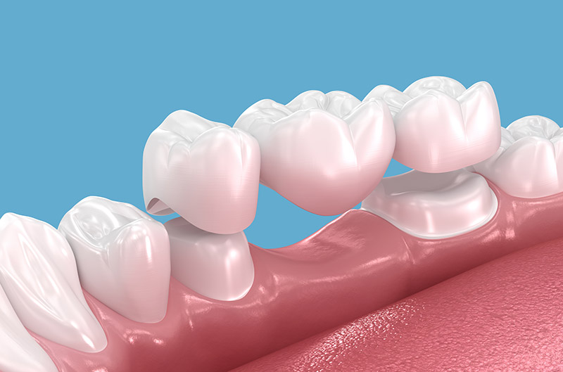 dental bridges