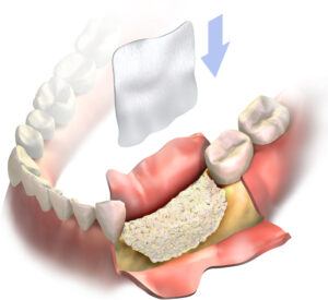 ridge augmentation bone grafting