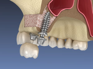 sinus lift surgery