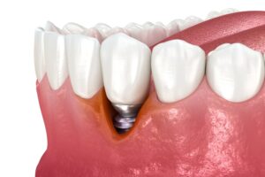 gum recession around implant site