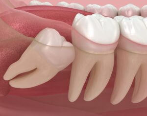 wisdom tooth impaction