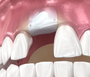 socket preservation and bone grafting